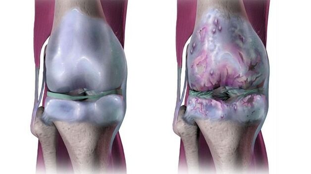 Υγιής άρθρωση του γόνατος και επηρεάζεται από οστεοαρθρίτιδα
