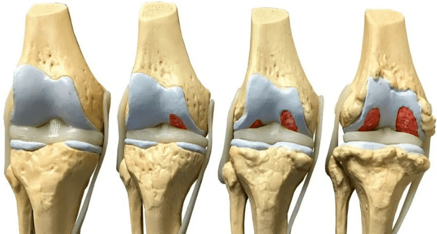 Βλάβη στην άρθρωση του γόνατος σε διάφορα στάδια ανάπτυξης της οστεοαρθρίτιδας