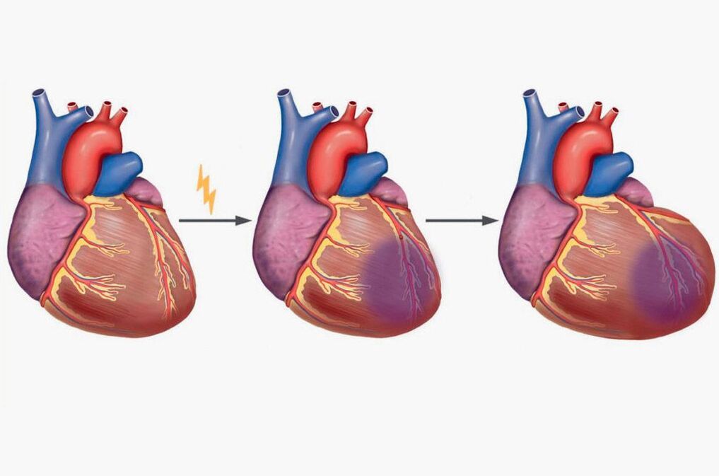 Η καρδιακή προσβολή προκαλεί πόνο στις ωμοπλάτες