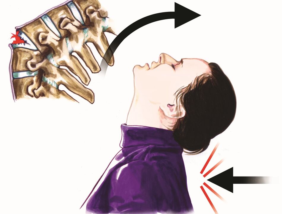 Βλάβη της σπονδυλικής στήλης ως αιτία πόνου στον αυχένα